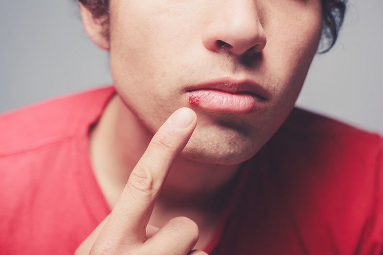 Treat cold sore early to avoid complications – Experts advises